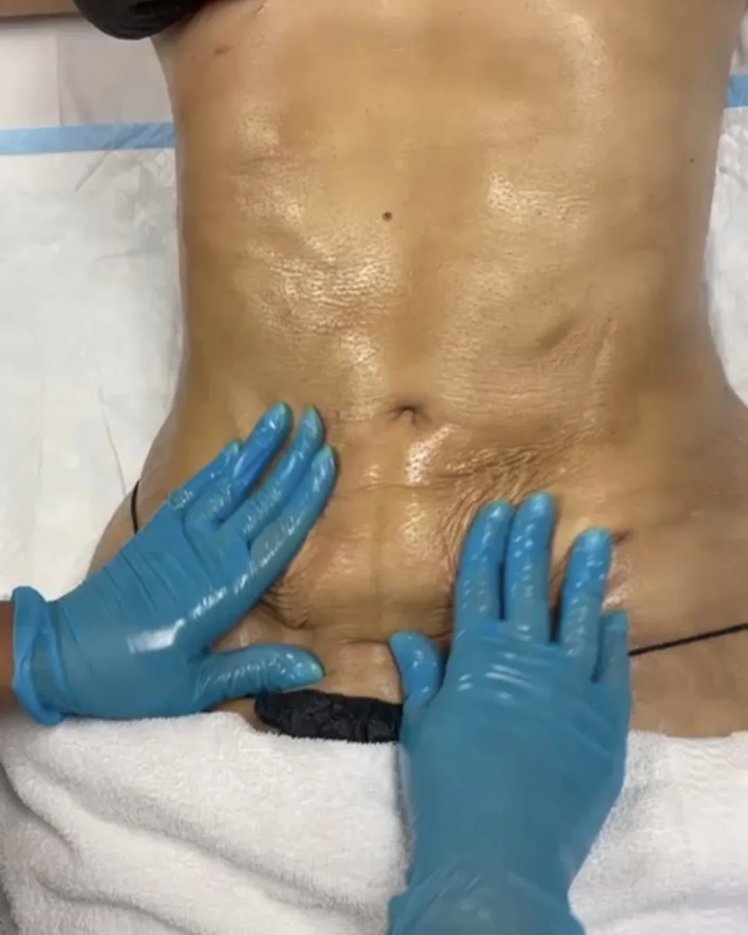 Post-surgical fibrosis treatment on the abdomen at Bambu Recovery, Houston