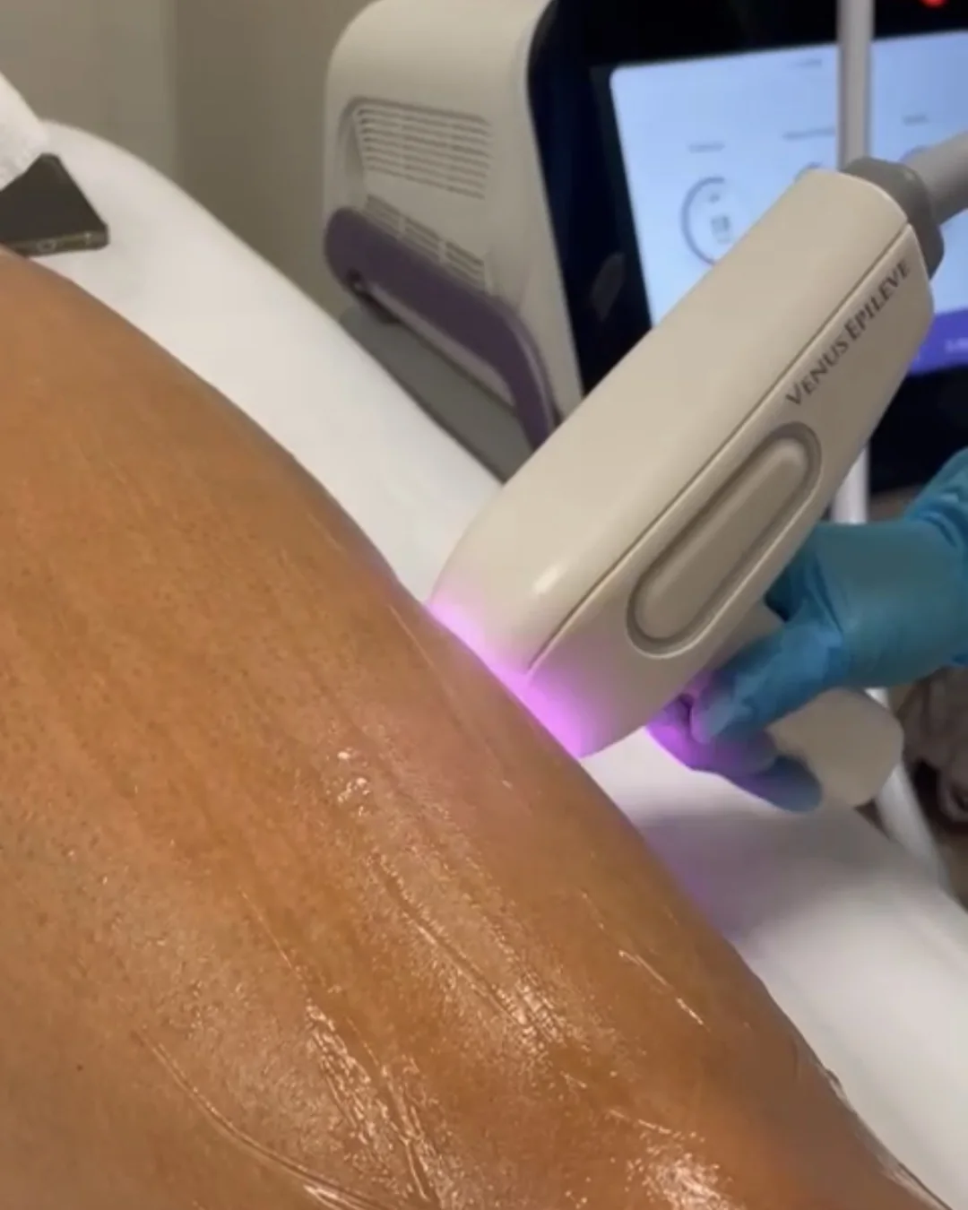 Laser hair removal with Venus Epileve at Bambu Recovery, Houston