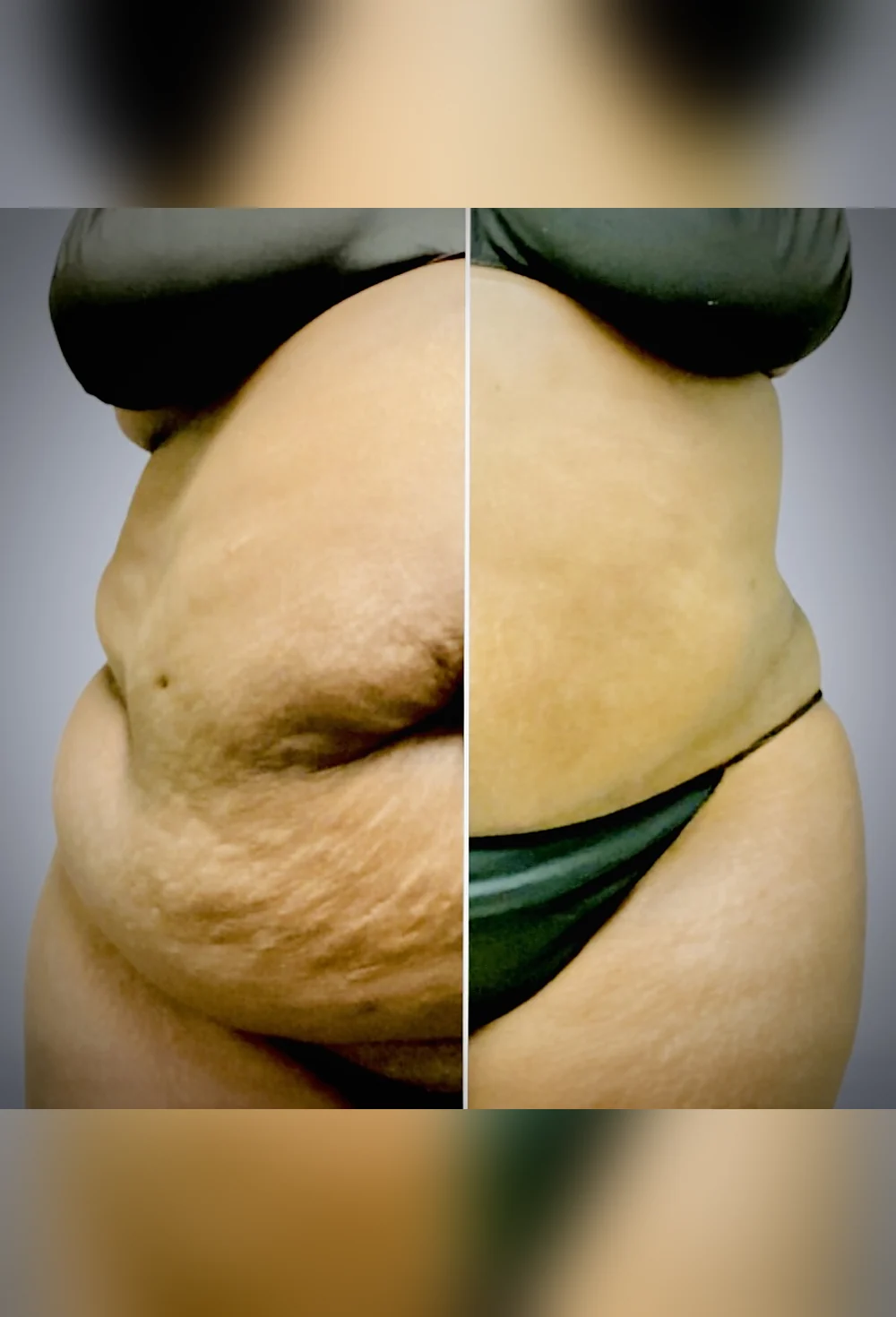 Before and after post-surgical recovery treatment at Bambu Recovery, Houston