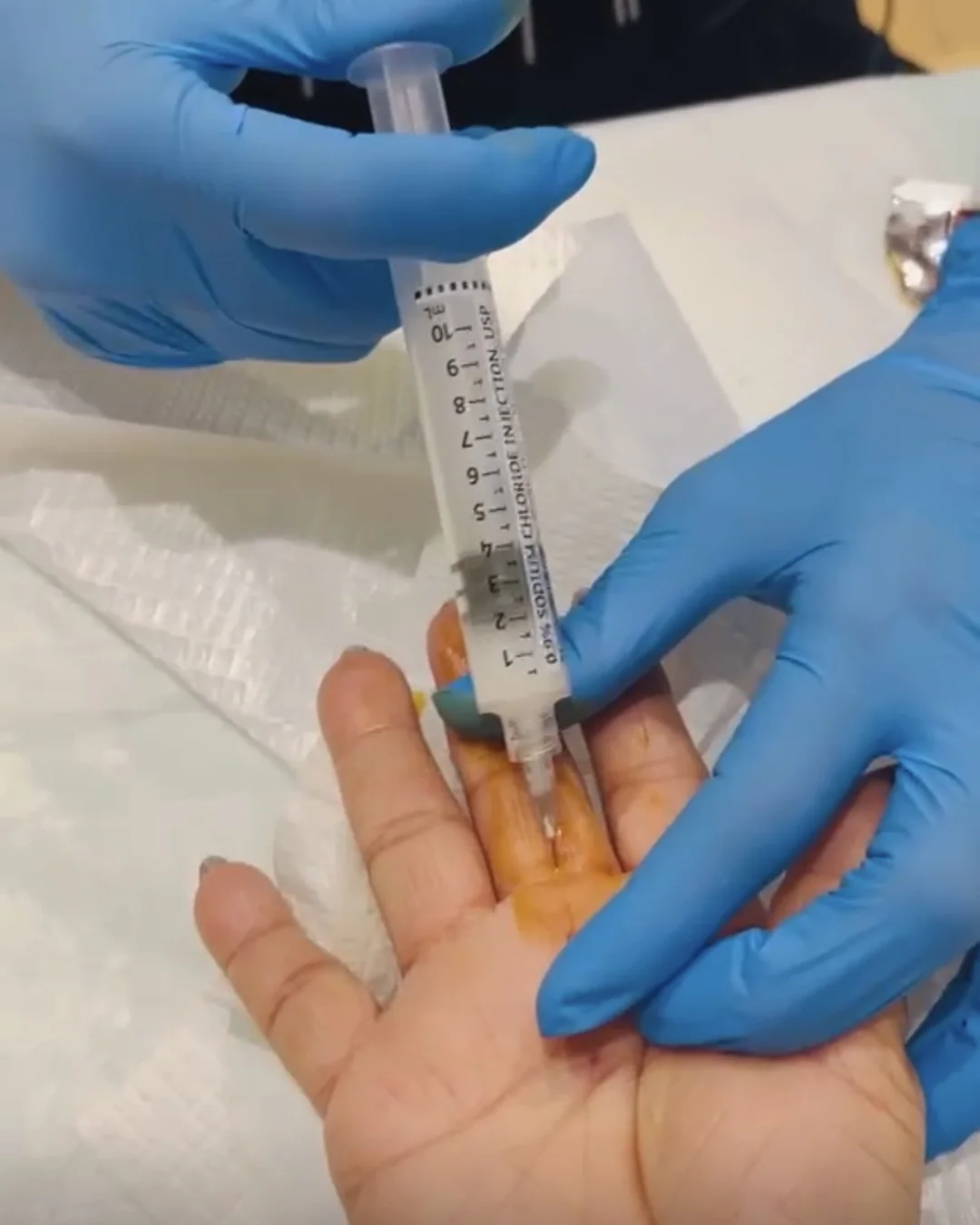Sterile syringe during a post-op wound care visit at Bambu Recovery