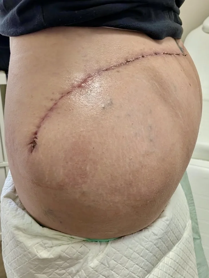 Abdominal incision during a post-op check at Bambu Recovery